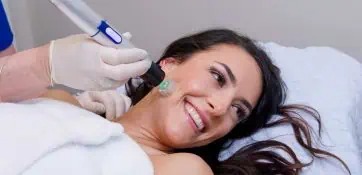 Radio frequency microneedling brandon florida