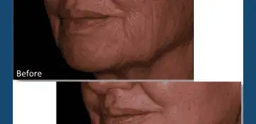 RF microneedling collagen induction therapy